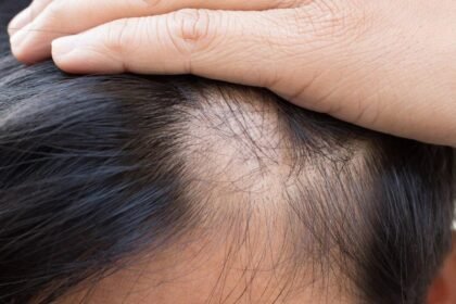 Silent Crown: A Practical Guide to Androgenetic Alopecia